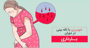  	خونریزی های دوران بارداری